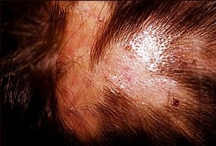 Folliculitis1